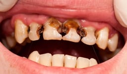 Sâu nhiều răng: Nguyên nhân và cách điều trị hiệu quả