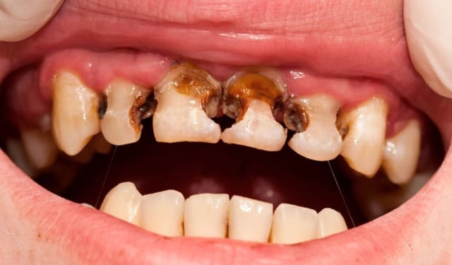 Sâu nhiều răng: Nguyên nhân và cách điều trị hiệu quả
