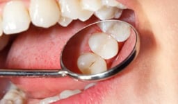 Sâu răng hàm nhẹ: Dấu hiệu ban đầu và cách xử lý đúng cách