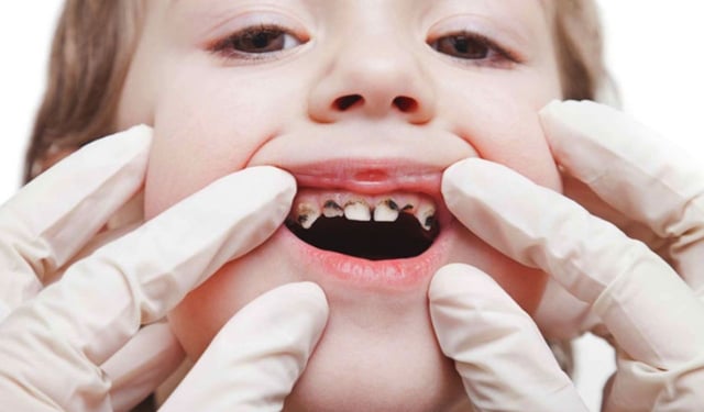 Sâu răng ở trẻ em: Nguyên nhân, dấu hiệu và cách phòng ngừa