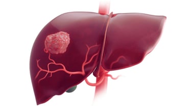 10 Câu hỏi thường gặp khi tư vấn ung thư gan – Giải đáp chi tiết
