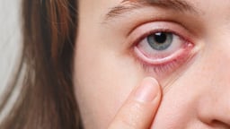 Viêm bờ mi có vảy &#8211; Hiểu biết và cách điều trị hiệu quả
