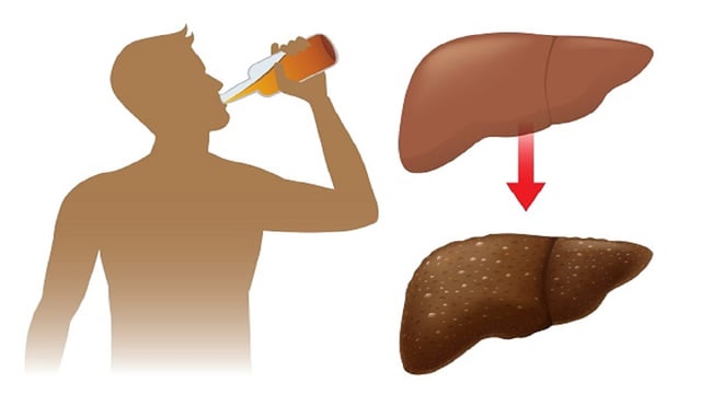 Viêm gan do rượu bia: Nguyên nhân, triệu chứng và cách điều trị hiệu quả