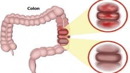 Viêm loét đại tràng chảy máu: Hiểu rõ để điều trị đúng cách