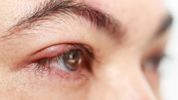 Hiểu biết về viêm tuyến bờ mi và cách điều trị hiệu quả