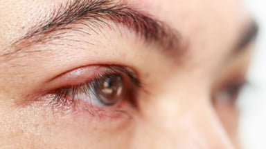 Hiểu biết về viêm tuyến bờ mi và cách điều trị hiệu quả