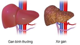 Xơ gan điều trị ra sao: Các phương pháp điều trị hiệu quả