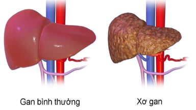 Xơ gan điều trị ra sao: Các phương pháp điều trị hiệu quả