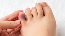 Những điều cần biết về bàn chân tiểu đường