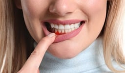 Dấu hiệu nhận biết khi bị viêm nha chu không nên bỏ qua