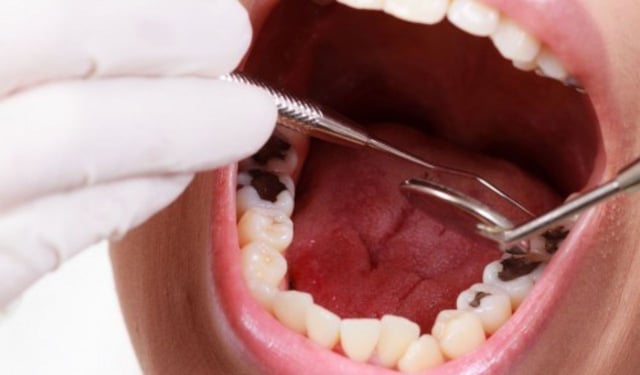 Cách khắc phục sâu răng hiệu quả giúp hạn chế biến chứng
