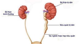Giãn đài bể thận nên kiêng gì: Chế độ dinh dưỡng cho người bệnh