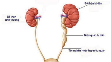 Giãn đài bể thận nên kiêng gì: Chế độ dinh dưỡng cho người bệnh