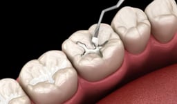 Mẹo chọn vật liệu hàn răng vĩnh viễn phù hợp nhất