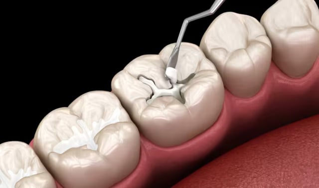 Mẹo chọn vật liệu hàn răng vĩnh viễn phù hợp nhất