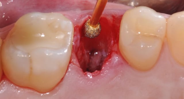 Nhổ răng khôn để lại lỗ: Bí quyết giảm sưng đau hiệu quả