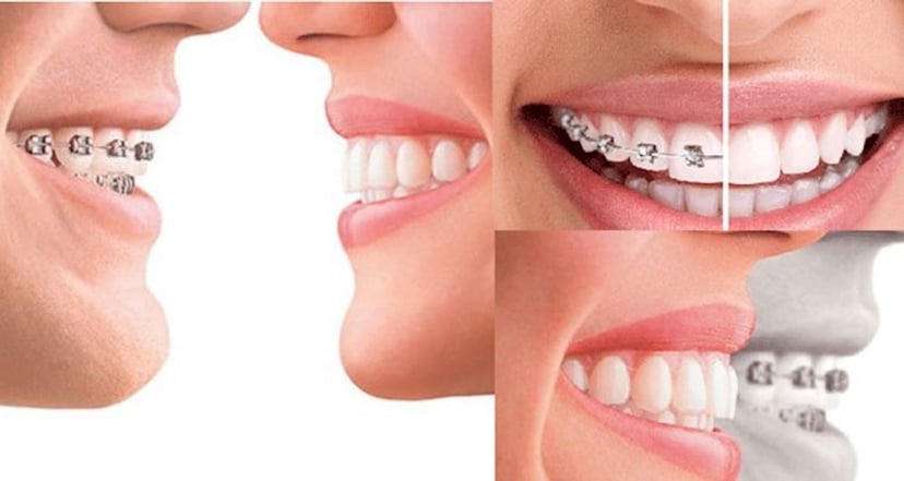 Niềng răng hay bọc sứ tốt hơn: Lời giải chuyên sâu từ A-Z