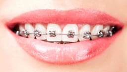 Niềng răng hô nhẹ có thực sự cần thiết hay không?