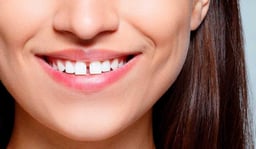 Phục hình răng thưa: Làm sao để duy trì kết quả lâu dài?
