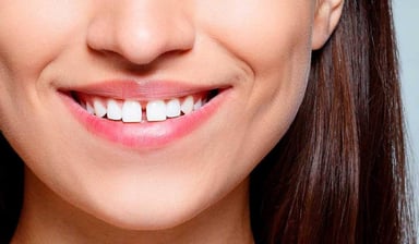 Phục hình răng thưa: Làm sao để duy trì kết quả lâu dài?