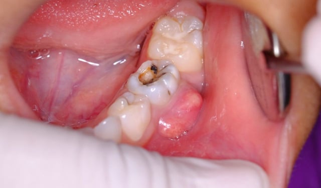 Sâu răng áp xe: Nguyên nhân, dấu hiệu và cách điều trị hiệu quả