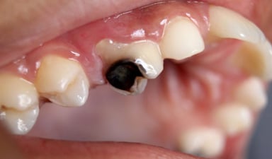Sâu răng là gì: Nguyên nhân, triệu chứng và cách phòng tránh