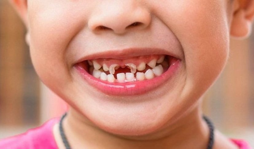 Dấu hiệu nhận biết sớm tình trạng sâu răng ở trẻ