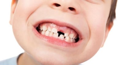 Sâu răng ở trẻ em: Hiểu đúng để bảo vệ răng miệng cho bé