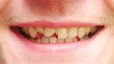 Những điều cần biết trước khi trám răng sâu sứt mẻ đạt hiệu quả