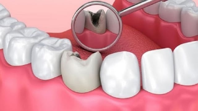 &#8220;Chìa khóa vàng&#8221; phòng ngừa và điều trị sâu răng tận gốc