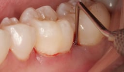 Điều trị viêm lợi đau răng: Những điều cần biết để tránh biến chứng