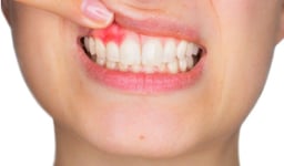 Đau răng viêm lợi: Nguyên nhân, triệu chứng và cách khắc phục