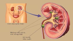 Bị sỏi tiết niệu có nguy hiểm không, phương pháp điều trị hiệu quả