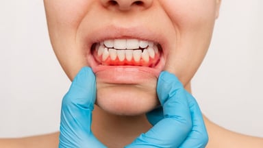 Cách trị sưng nướu răng trong cùng tại nhà hiệu quả và an toàn