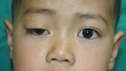 Mắt sụp mí có nguy hiểm không? Cách khắc phục nhanh, an toàn