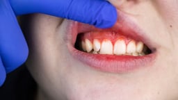 Sưng lợi hàm trên: Cảnh báo bệnh lý răng miệng nguy hiểm