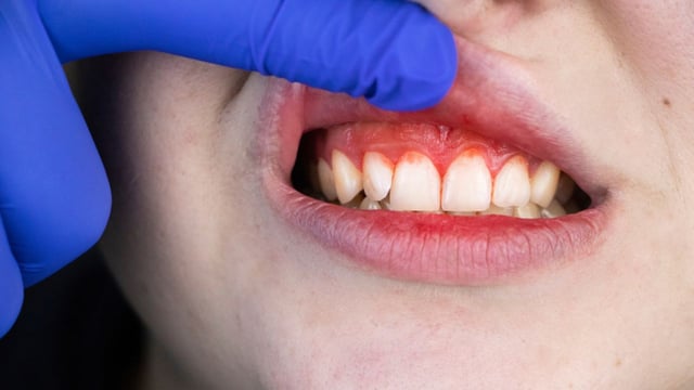 Sưng lợi hàm trên: Cảnh báo bệnh lý răng miệng nguy hiểm