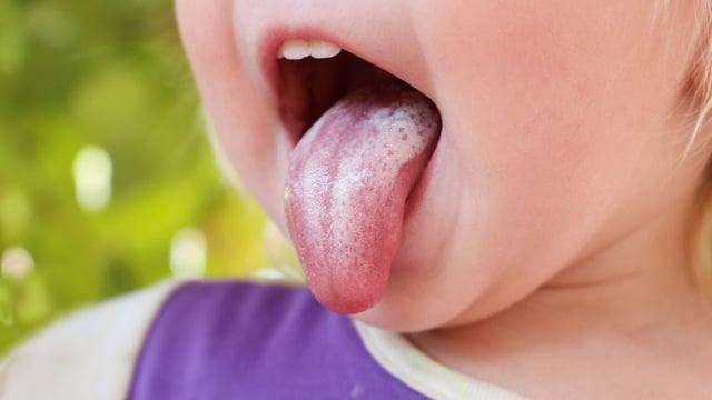 Tưa miệng: Những điều bạn cần biết