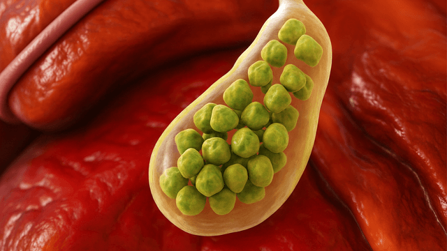 Sỏi bùn túi mật: Ít triệu chứng, diễn biến âm thầm