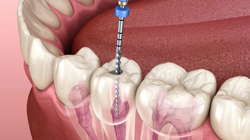 Khi nào cần điều trị tuỷ răng? Dấu hiệu nhận biết sớm nhất