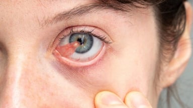 Mộng thịt mắt là gì? Nguyên nhân, triệu chứng và cách xử lý