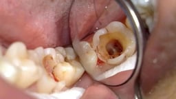 Răng sâu vào tuỷ: Dấu hiệu nhận biết sớm và cách chữa hiệu quả