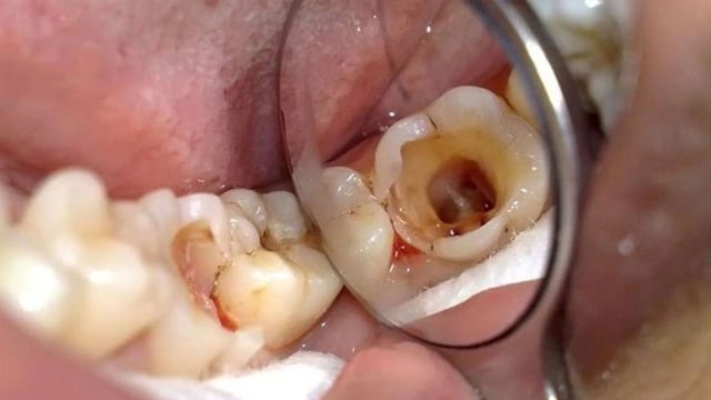 Răng sâu vào tuỷ: Dấu hiệu nhận biết sớm và cách chữa hiệu quả