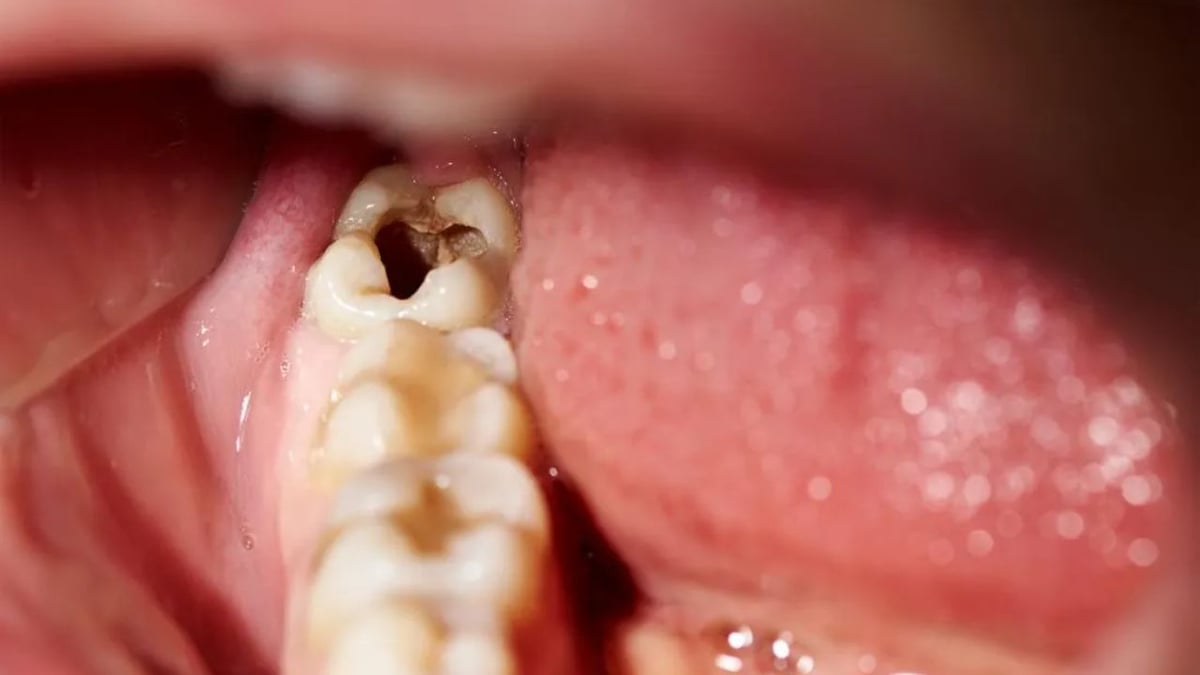 Răng số 7 bị sâu vỡ: Hướng dẫn cách chăm sóc và điều trị