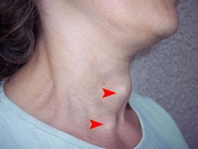 Khám bệnh bướu cổ ở đâu