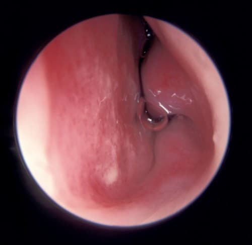 bị viêm mũi nên uống thuốc gì?