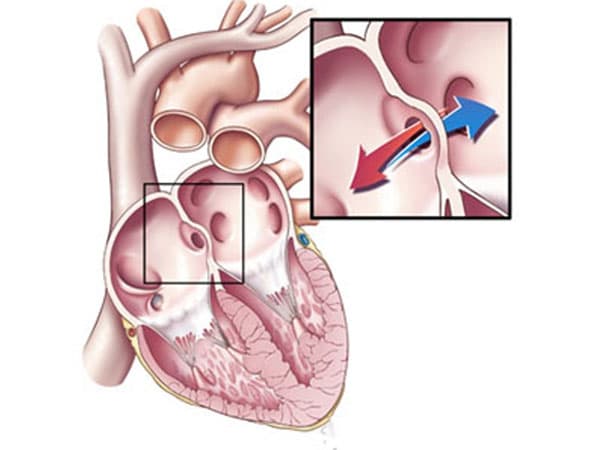 Khi mắc bệnh thông liên nhĩ, vạch phân chia bị và hai buồng tim này thông nhau dẫn tới cơ thể bị thiếu oxy