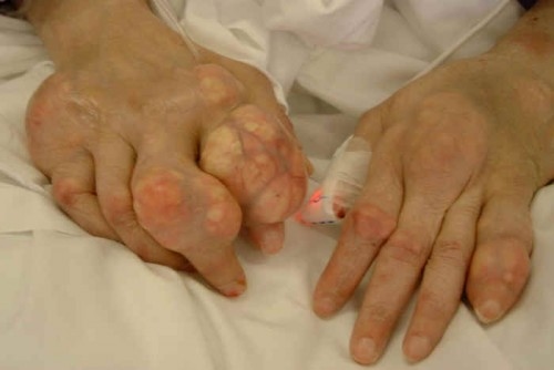 dau-khop-ngon-tay-tro-co-phai-benh-gout2