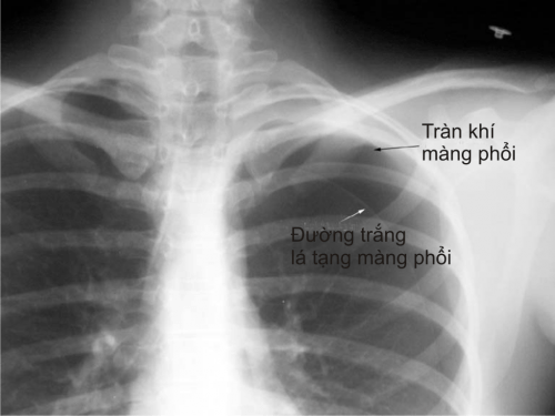trieu-chung-khi-bi-tran-dich-mang-phoi.jpg2