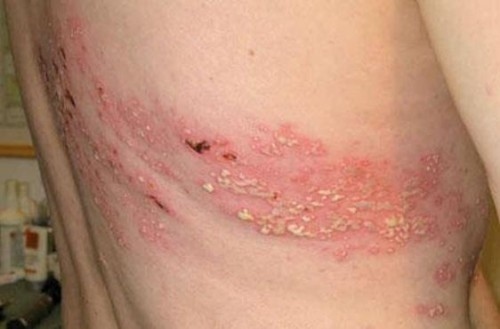 Zona là một trong những nguyên nhân gây chứng đau thần kinh liên sườn
